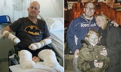 باکتری گوشتخوار مرد را تکه تکه کرد! +عکس باکتری گوشتخوار مرد را تکه تکه کرد! +عکس